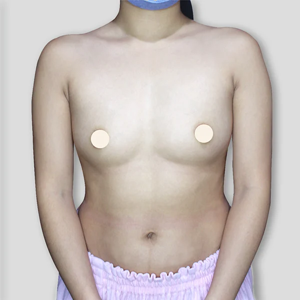 Breast Case01 Before Watermark0