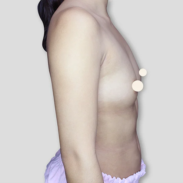 Breast Case01 Before Watermark90