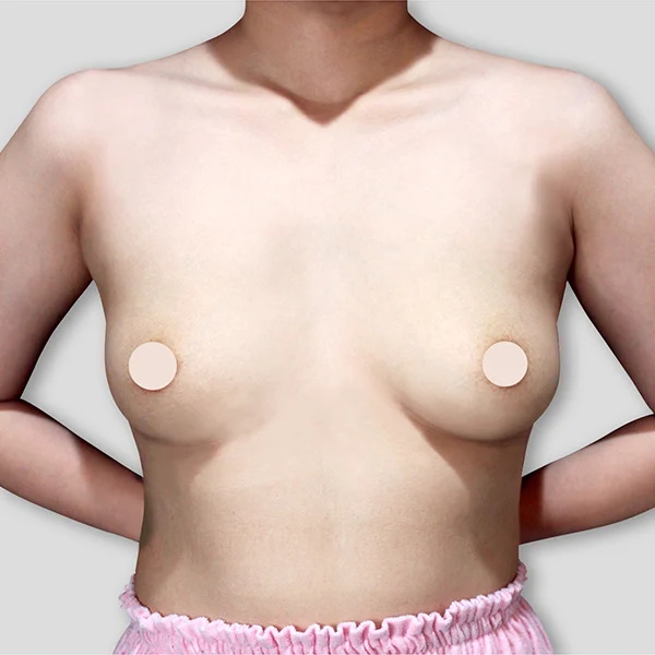 Breast Case03 Before Watermark0