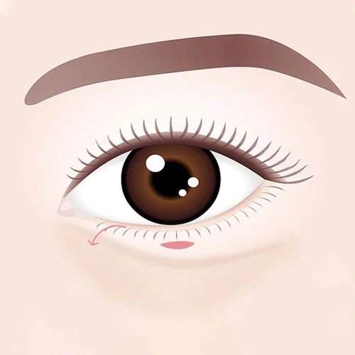 Eye Bags Surgery 02 2