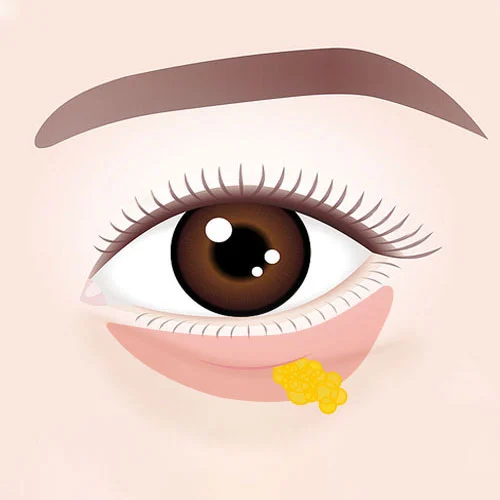 Eye Bags Surgery 01 2