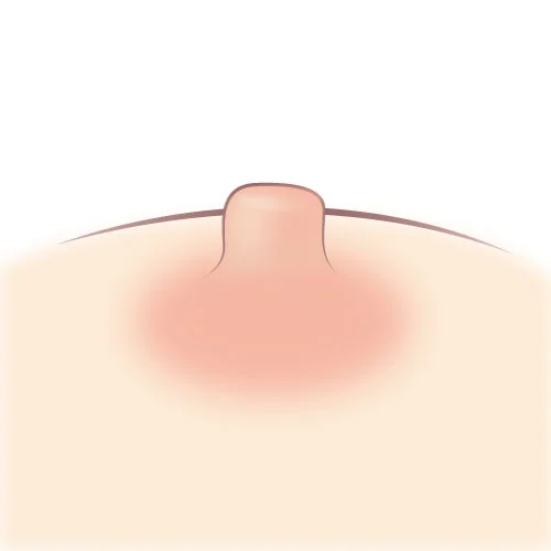 Nipple Reduction02 1