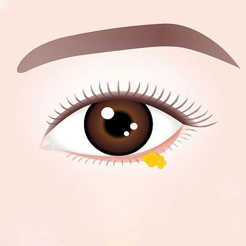 Eye Bags Surgery 02 3