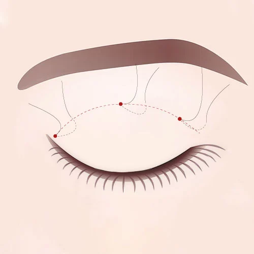 Double Eyelid Surgery 02 3