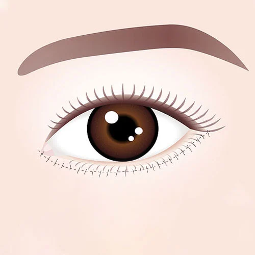 Eye Bags Surgery 01 4