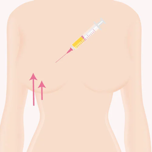 Autoplasty Breast01 4