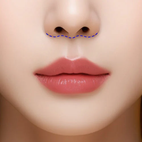 Lip Shortening 01 1
